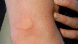 איך לטפל בכוויות