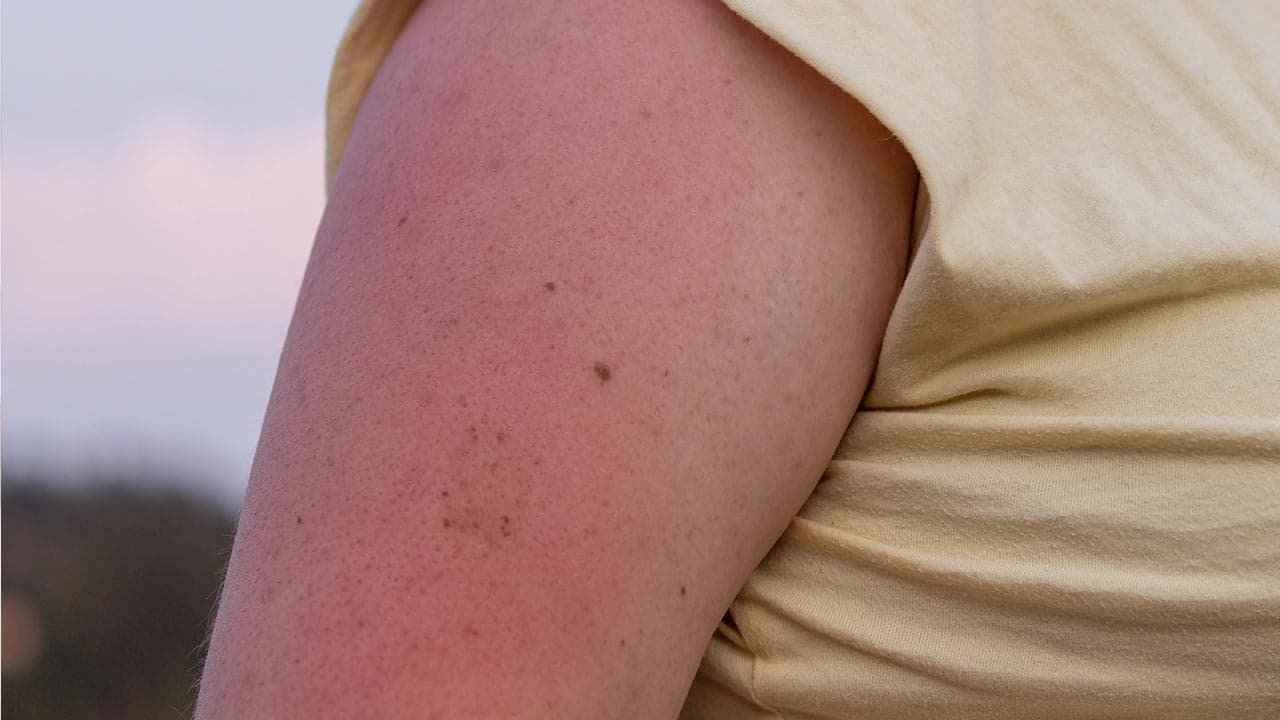 איך מטפלים בכוויה